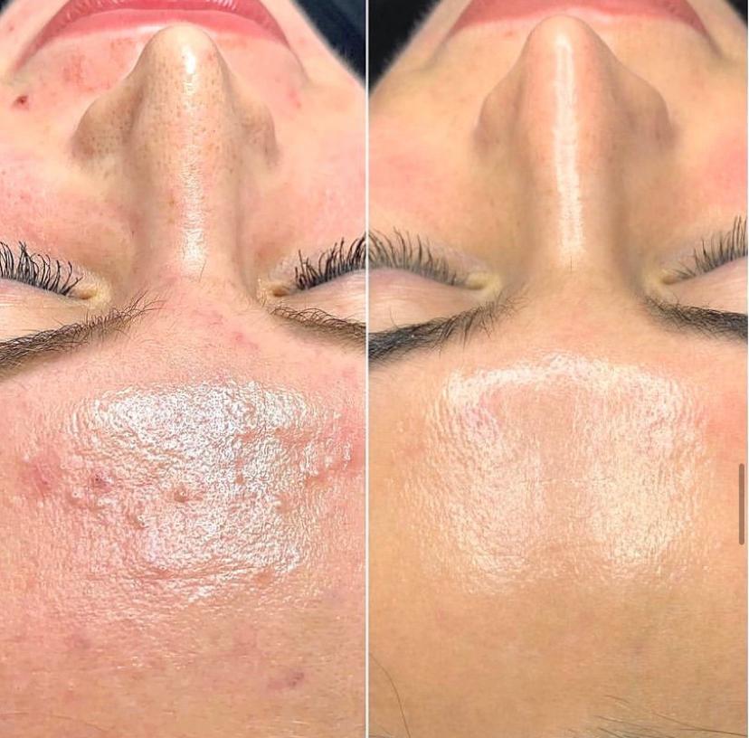 prx skin peel aging